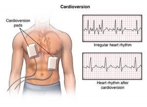 DC-Cardioversion