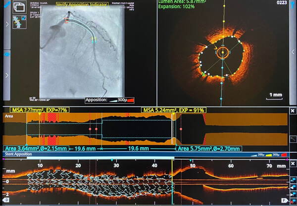 Precision PCI - Optical Coherence Tomography