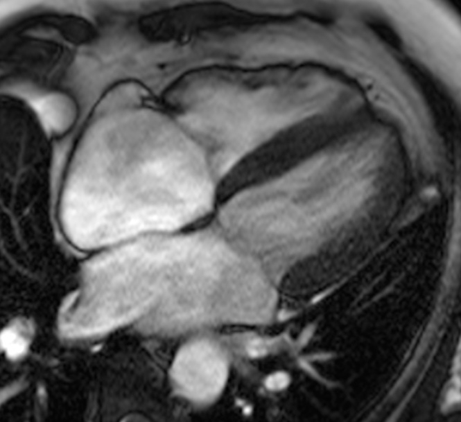 Why Is Cardiac MRI Done? Understanding Heart Imaging