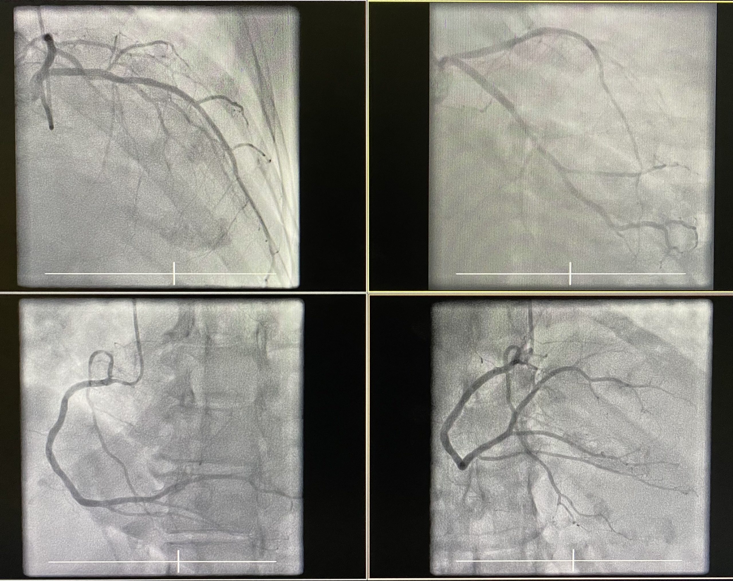 Who Performs Percutaneous Coronary Intervention?