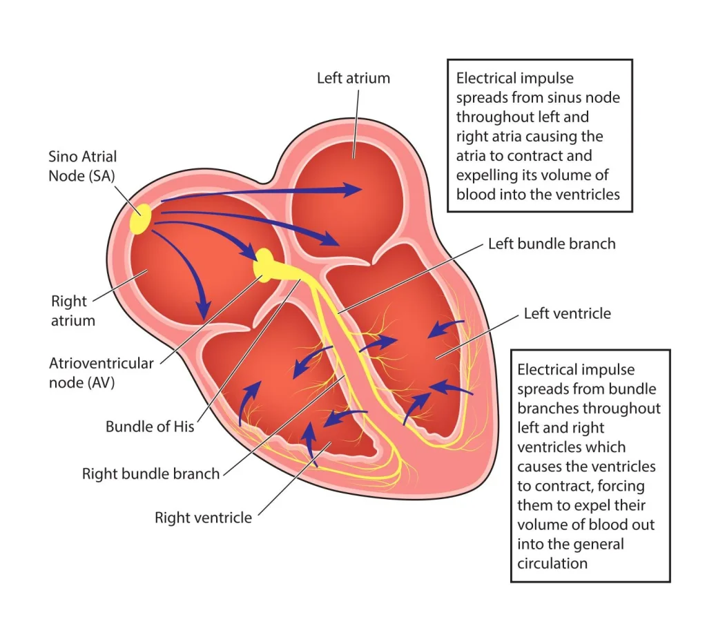 Illustration of a pacemaker implanted below the collarbone with leads connected to the chambers of the heart.