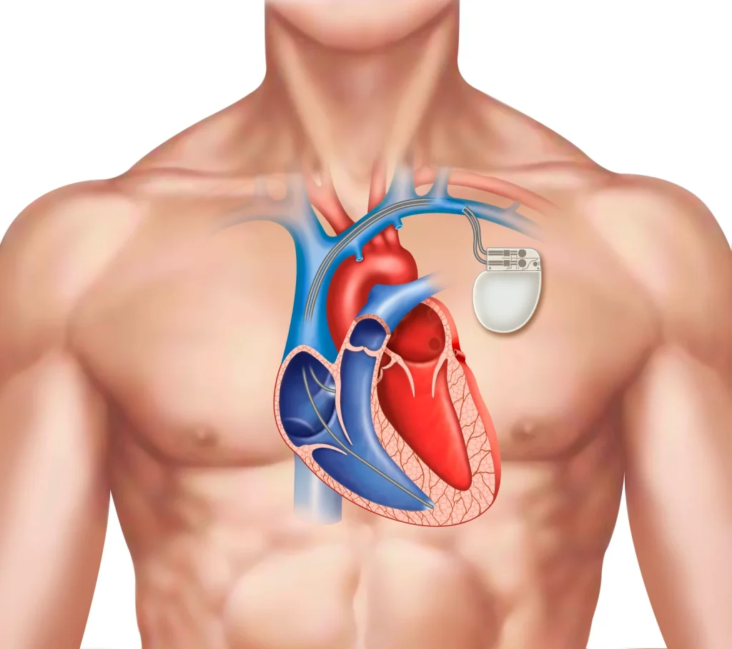When Is a Pacemaker Needed? Signs, Reasons and Timing